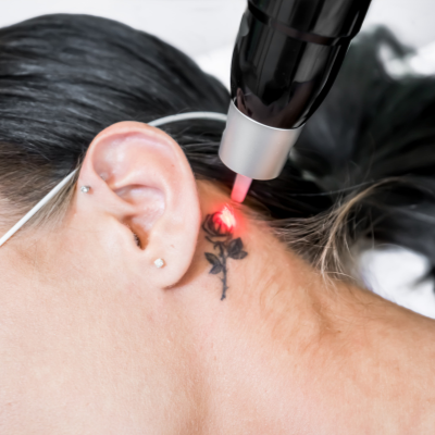 tattoo removal